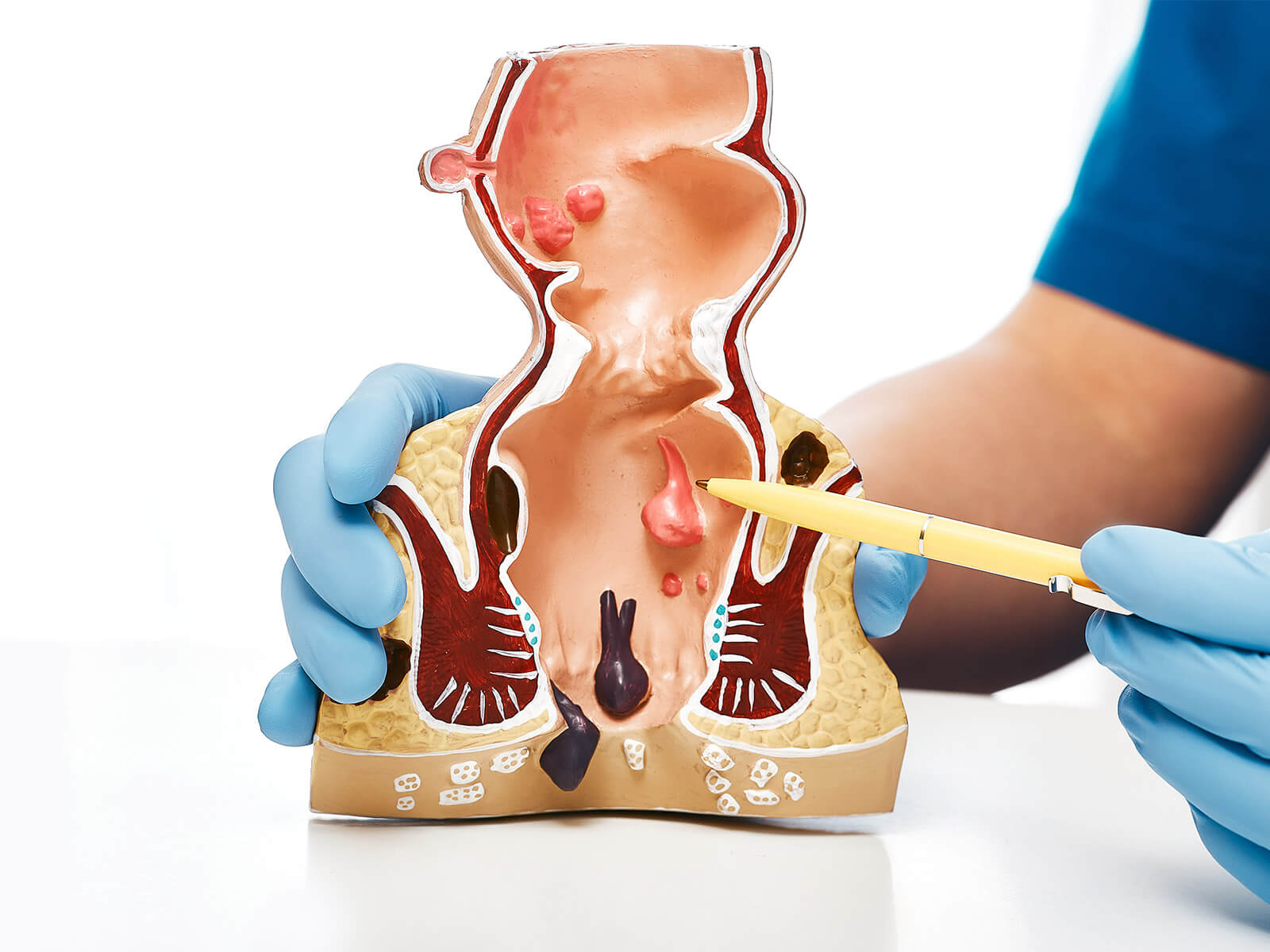 Rectal